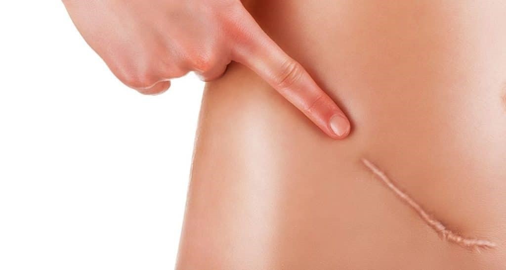 Surgical scar removal in Pune Clinique Internationale